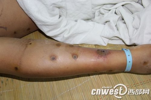 白河医院成功救治一例毒蜂蜇伤患者